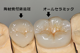 セラミックのかぶせ物について