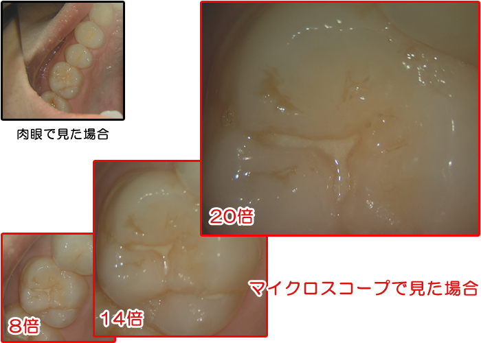 肉眼と歯科用マイクロスコープで見る違い